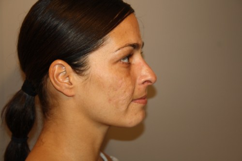 Suzan vor ihrem ersten Needling